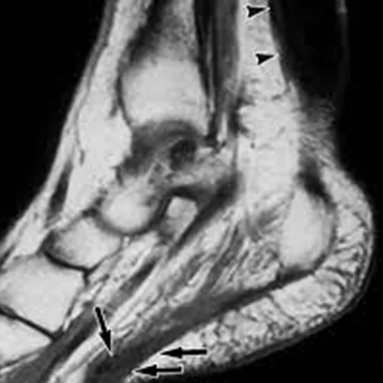 MRI Left Heel